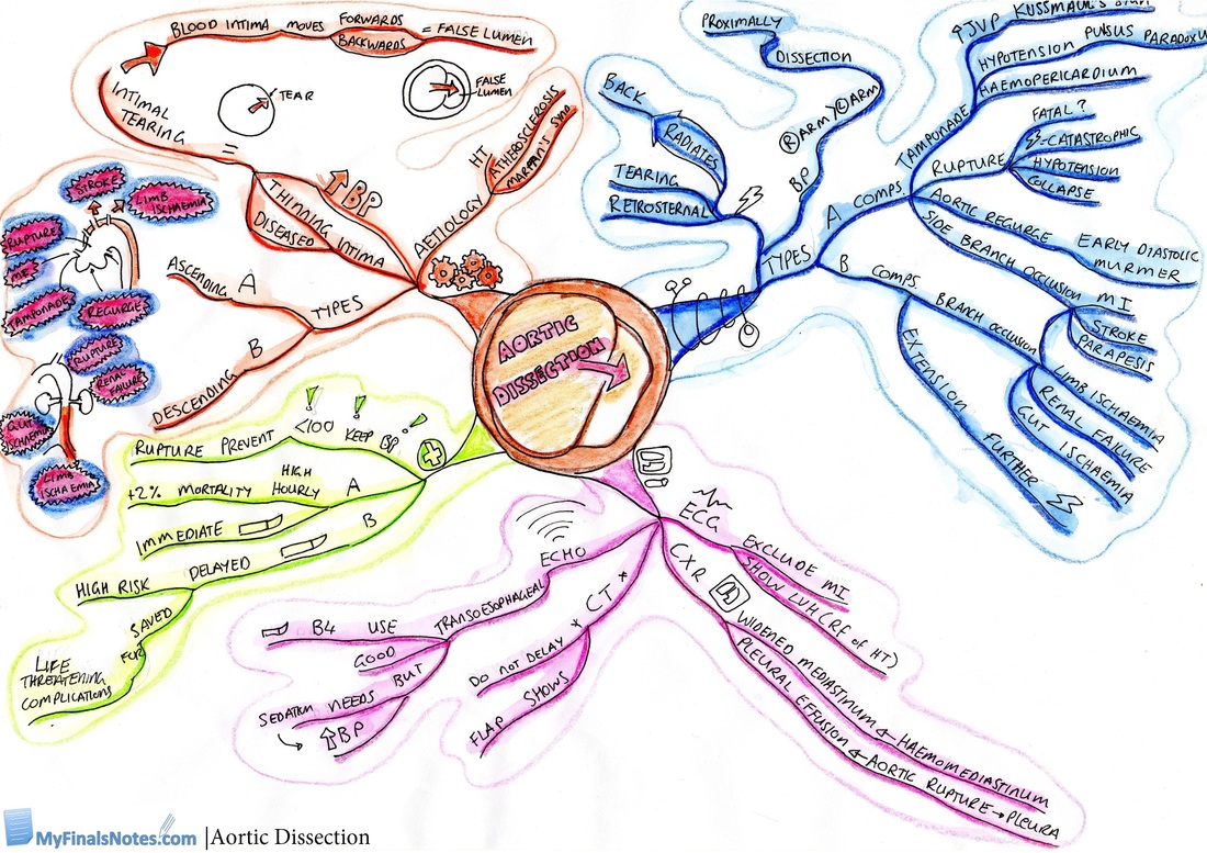 Aortic dissection mind map, pathophysiology, clinical features, investigations, management